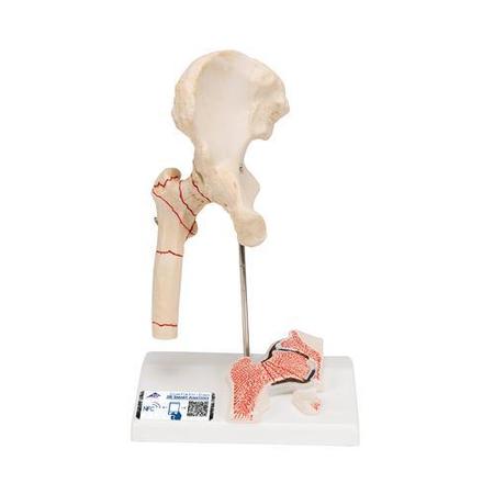 3B SCIENTIFIC Femoral Fracture - w/ 3B Smart Anatomy 1000175